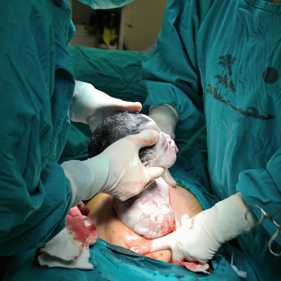 Being born by Caesarian section may affect your intelligence | Faculty of  Medicine | UiB
